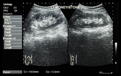 What Causes Struvite & Staghorn Kidney Stones? | Blog | www.lencolab.com