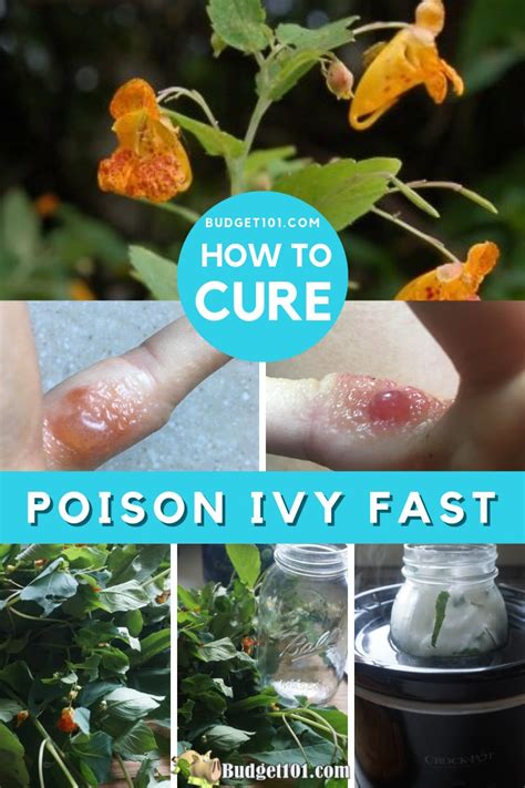 How Is Poison Ivy Treatment