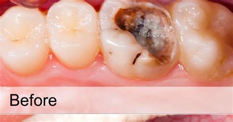 TOOTH CAVITY FILLING TREATMENT - MATRIX DENTAL AND SKIN LOUNGE