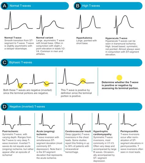 ECG Interpretation: Characteristics Of The Normal ECG, 58% OFF