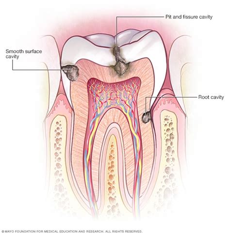 Cavities/tooth decay - Symptoms and causes (2022)