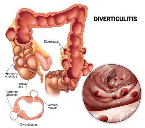 Lower Left Abdominal Pain - Manhattan Gastroenterology