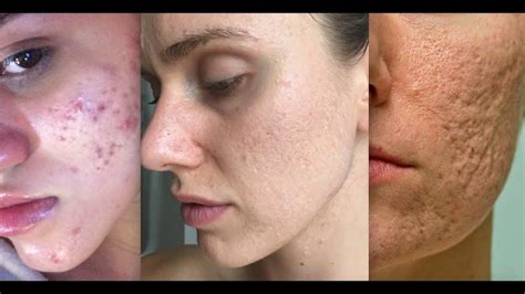 7 Best Acne Scar Treatments Recommended by Dermatologists – Available Ideas