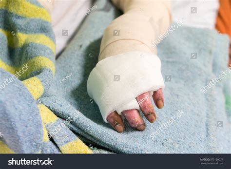 Nursing Care Patient Burn Unit Hospital Stock Photo 575159071 | Shutterstock