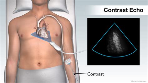 Types of Heart Ultrasound | See My Heart American Society of Echocardiography