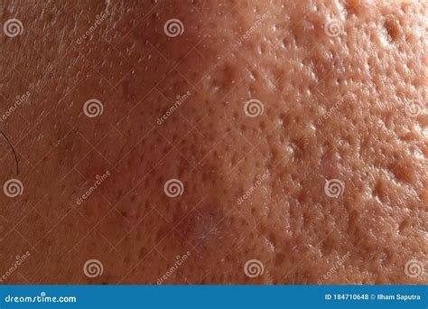 Close Up Photo of Nodular Cystic Acne Skin. Stock Photo - Image of ...