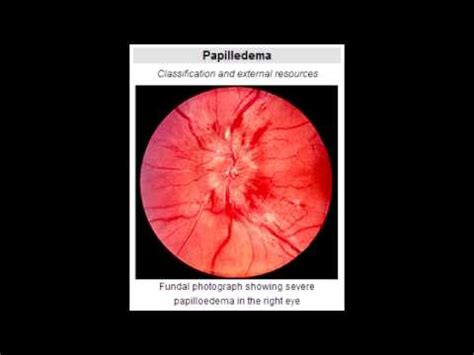 Papilledema - Define & Causes - YouTube