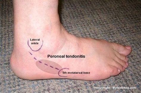 Peroneal Tendonitis | Causes and treatment options (Printer-friendly version)