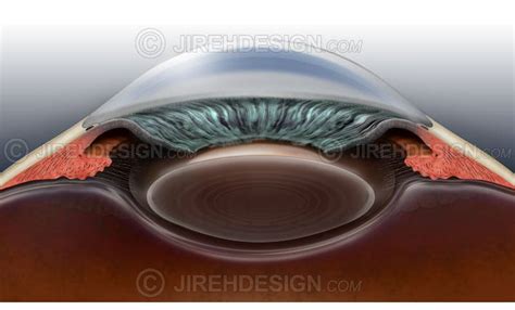 Narrow angle glaucoma - #CO0049 - Stock eye images