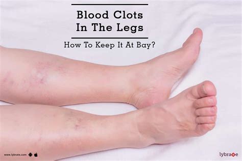 blood clot in leg - blood clot in legblood clot in legblood clot in leg