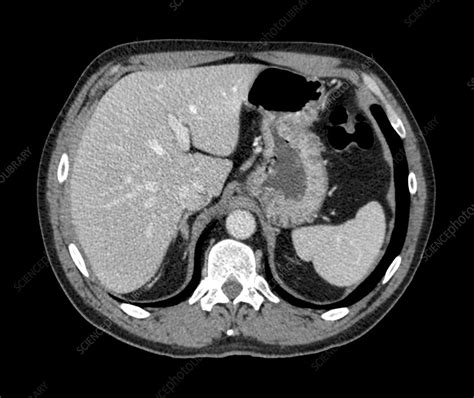 Normal liver and spleen, CT scan - Stock Image - C014/7032 - Science Photo Library