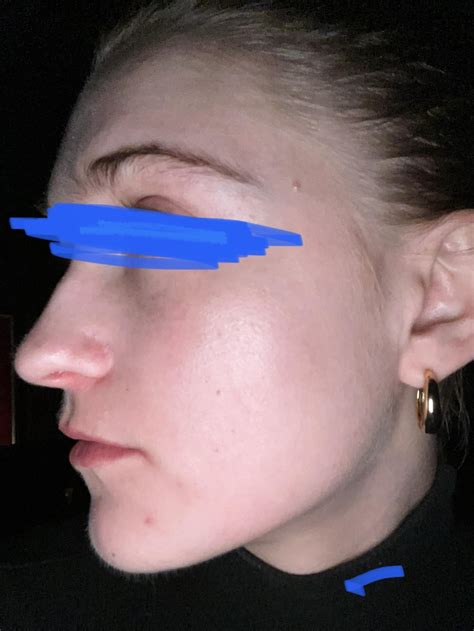 [Routine Help] Differin Gel and BP Wash Purge? : r/SkincareAddiction