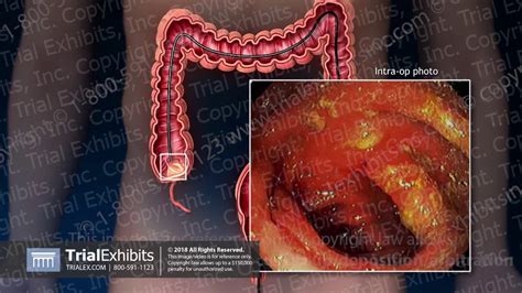 Colonoscopy with Polyp Removal - YouTube