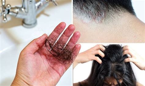 Hair loss treatment: Anti-fungal medicine could really work if you have ringworm | Express.co.uk