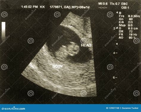 Ultrasound of a Fetus at 8 Weeks 1 Day Stock Photo - Image of ...