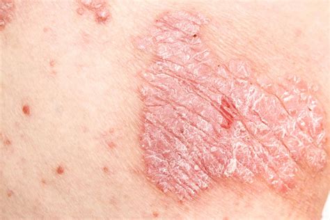 Psoriasis: Causes, Types and Treatment - Dermatological Society of Singapore