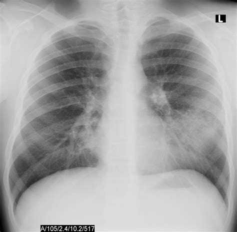 mycoplasma pneumoniae rash - pictures, photos