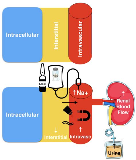 The Paradox of Hypertonic Saline Use in Heart Failure - Renal Fellow Network