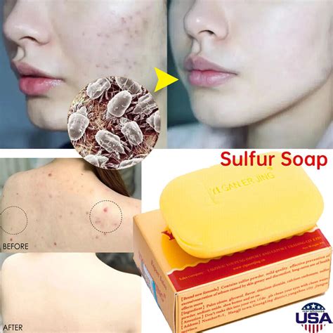 Sulfur Soap Before And After