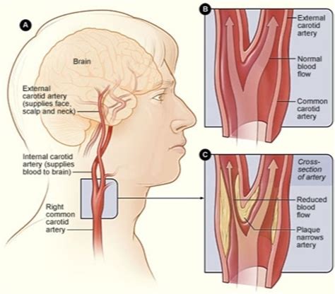 Carotid Artery Stenosis