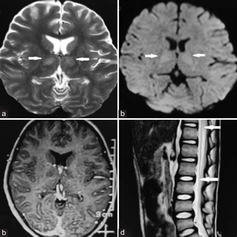 (a) MRI brain axial T2W image shows hyperintensities in bilateral... | Download Scientific Diagram