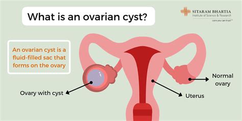 Complex Ovarian Cyst Symptoms