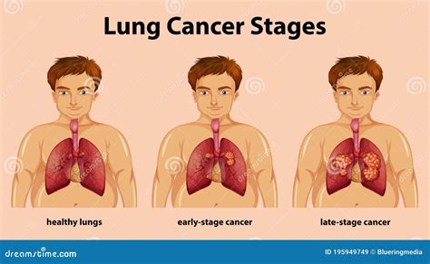 Informative Illustration of Lung Cancer Stages Stock Vector - Illustration of human, body: 195949749