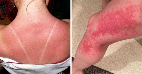 5 Signs Your Sunburn Is Actually Sun Poisoning