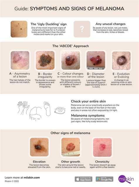 Stage 2 Nodular Melanoma