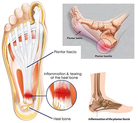 Heel Pain Treatment Specialist | Top Foot Doctor, Podiatrist NYC