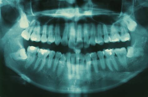 Impacted Wisdom Teeth X Ray Photos - TeethWalls