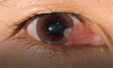 Pterygium causes, symptoms, diagnosis, treatment & pterygium eye surgery