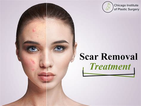 Best Treatments for The Removal of Scar and Make Your Skin Smooth