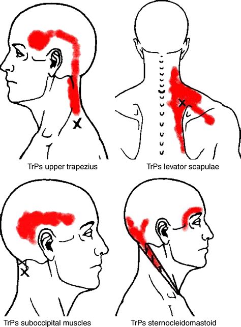 Levator Scapulae Trigger Points