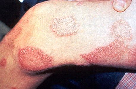 Leprosy - Wikipedia