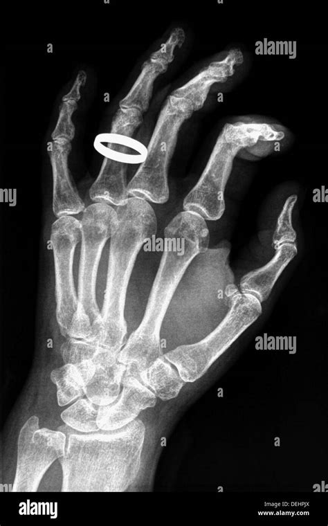 Hand bones X-ray with a ring Stock Photo - Alamy