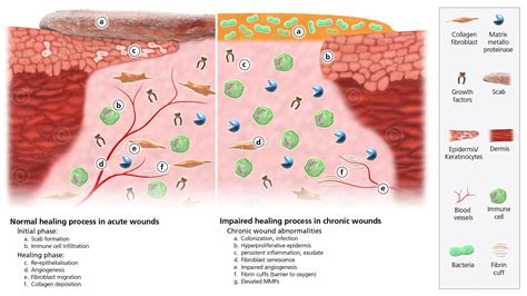 Comparison chronic and acute wound | Chronic, Wind, Healing process