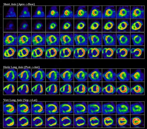 Understanding Your PET Scan Results | PET Scan Mumbai