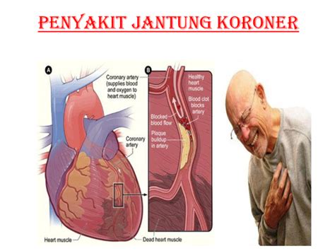 (PPT) PENYAKIT JANTUNG KORONER | Aq Mw - Academia.edu