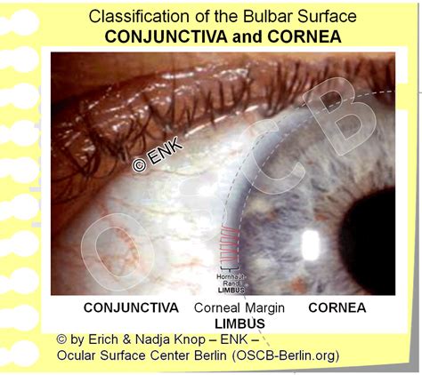 The CORNEA — Ocular Surface Center Berlin