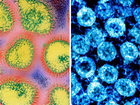 How The Novel Coronavirus And The Flu Are Alike ... And Different | NCPR News