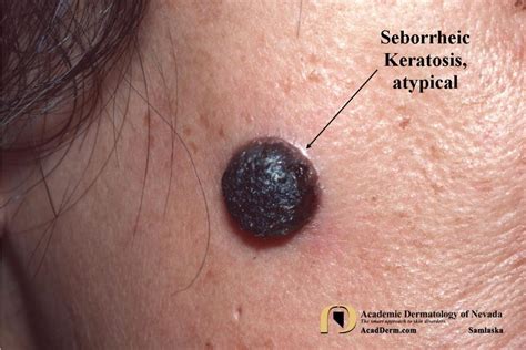 Seborrheic Keratosis: Atypical Forms... - Academic Dermatology of Nevada