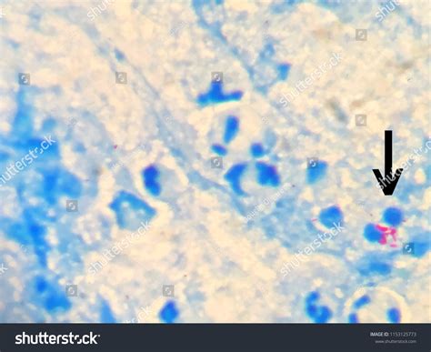 24 Ziehl Neelsen Stain Images, Stock Photos & Vectors | Shutterstock