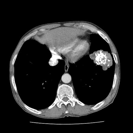 Pulmonary hamartoma | Radiology Reference Article | Radiopaedia.org