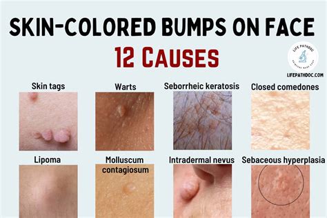 Skin Colored Bumps on Face: 12 Causes, Pictures & Treatment