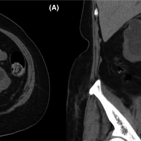 (PDF) Pyonephrosis drained by double‐J catheter