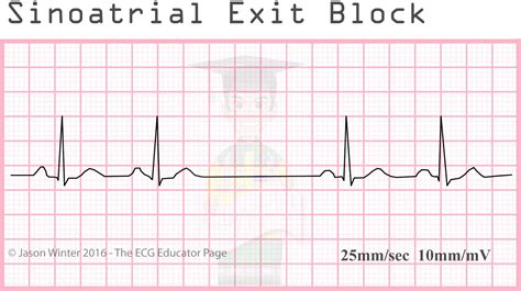 ECG Educator Blog : Sinoatrial Node rhythms