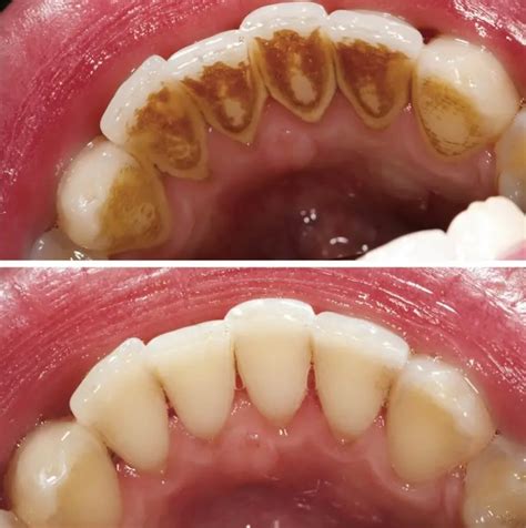 Teeth scaling procedure results before and after