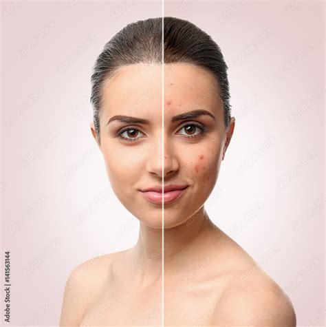 Woman face before and after acne treatment procedure. Skin care concept. Stock Photo | Adobe Stock