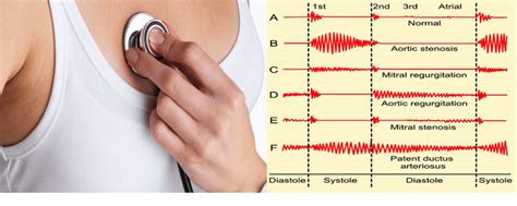 Heart Murmurs: Signs and Symptoms | Things Health